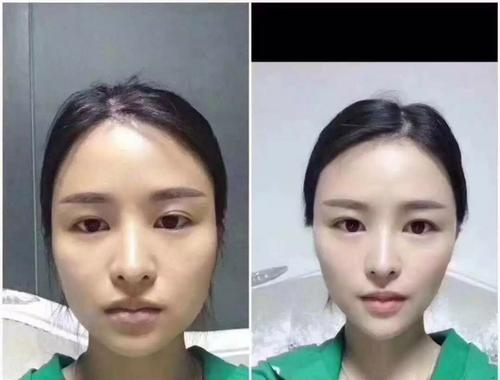 面部提升术