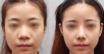 面部提升术
