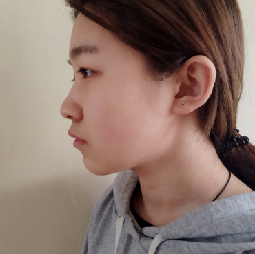 长效玻尿酸