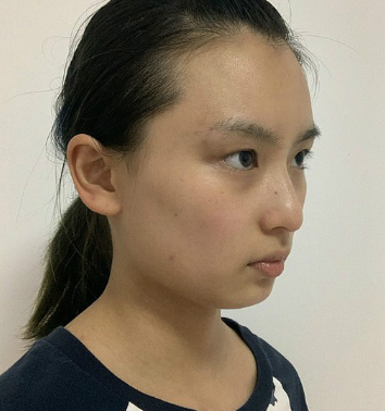双眼皮手术
