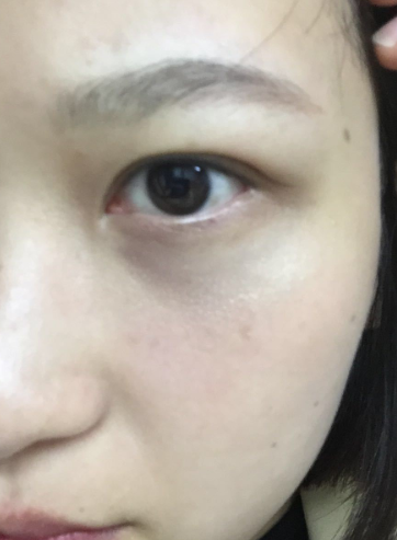 去眼袋手术