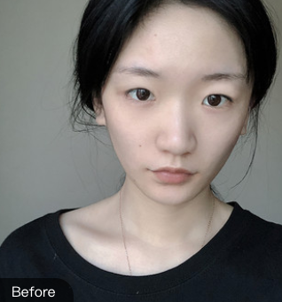 双眼皮手术