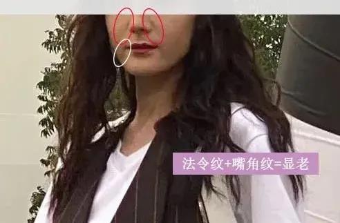 面部提升术