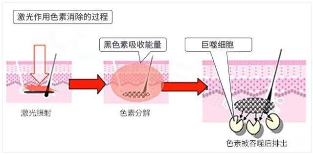 超皮秒祛斑