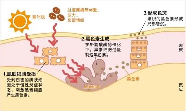 超皮秒祛斑