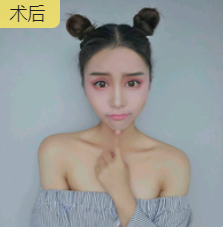 双眼皮手术
