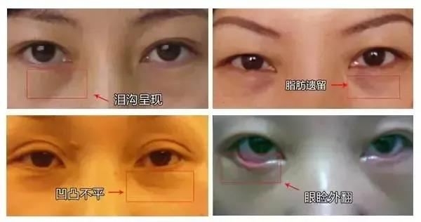 去眼袋手术