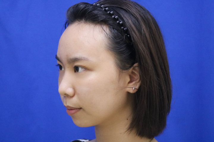 去眼袋手术