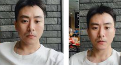 去眼袋手术