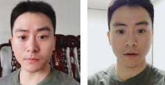 去眼袋手术