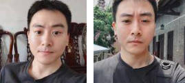 去眼袋手术