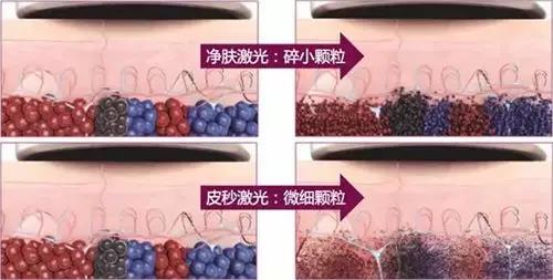 超皮秒祛斑