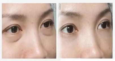 去眼袋手术