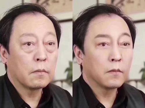 去眼袋手术