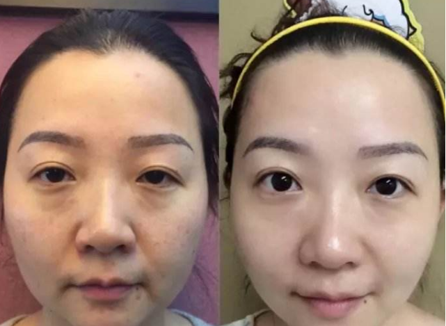 去眼袋手术