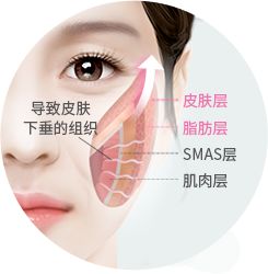 面部提升术