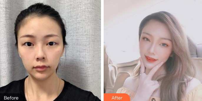 双眼皮手术