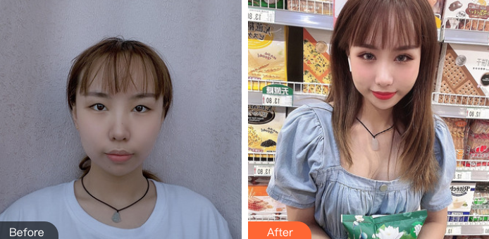 双眼皮手术