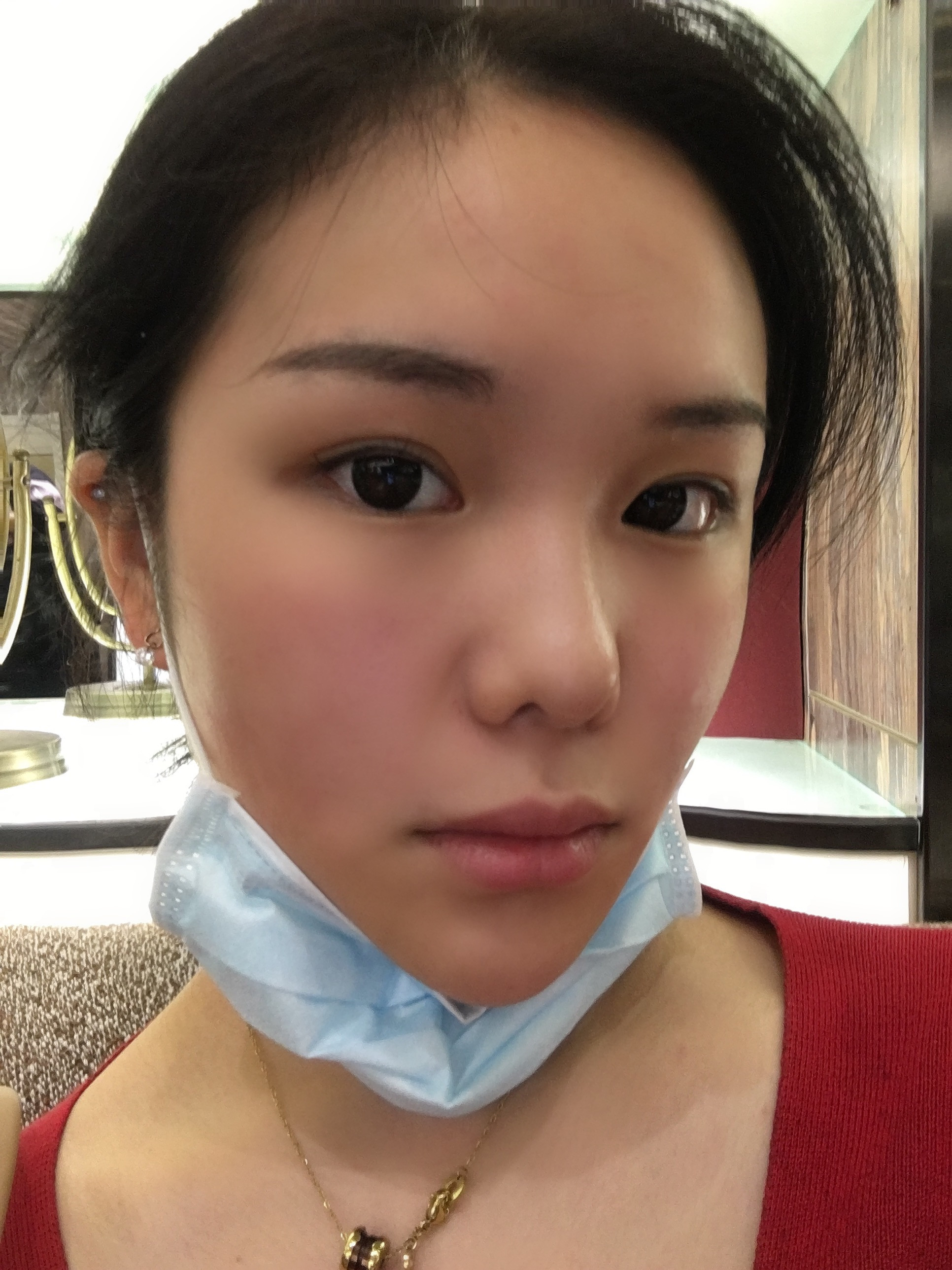 长效玻尿酸