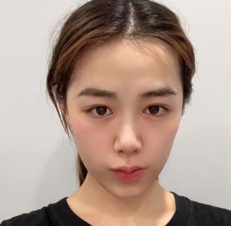 面部提升术