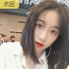 双眼皮手术