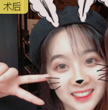 双眼皮手术