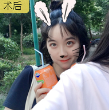双眼皮手术