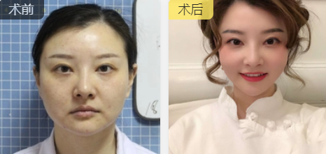 面部提升术