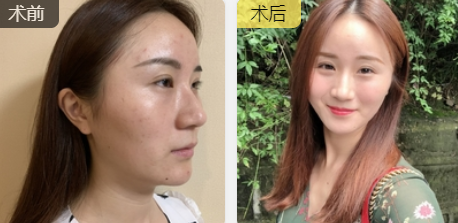 面部提升术