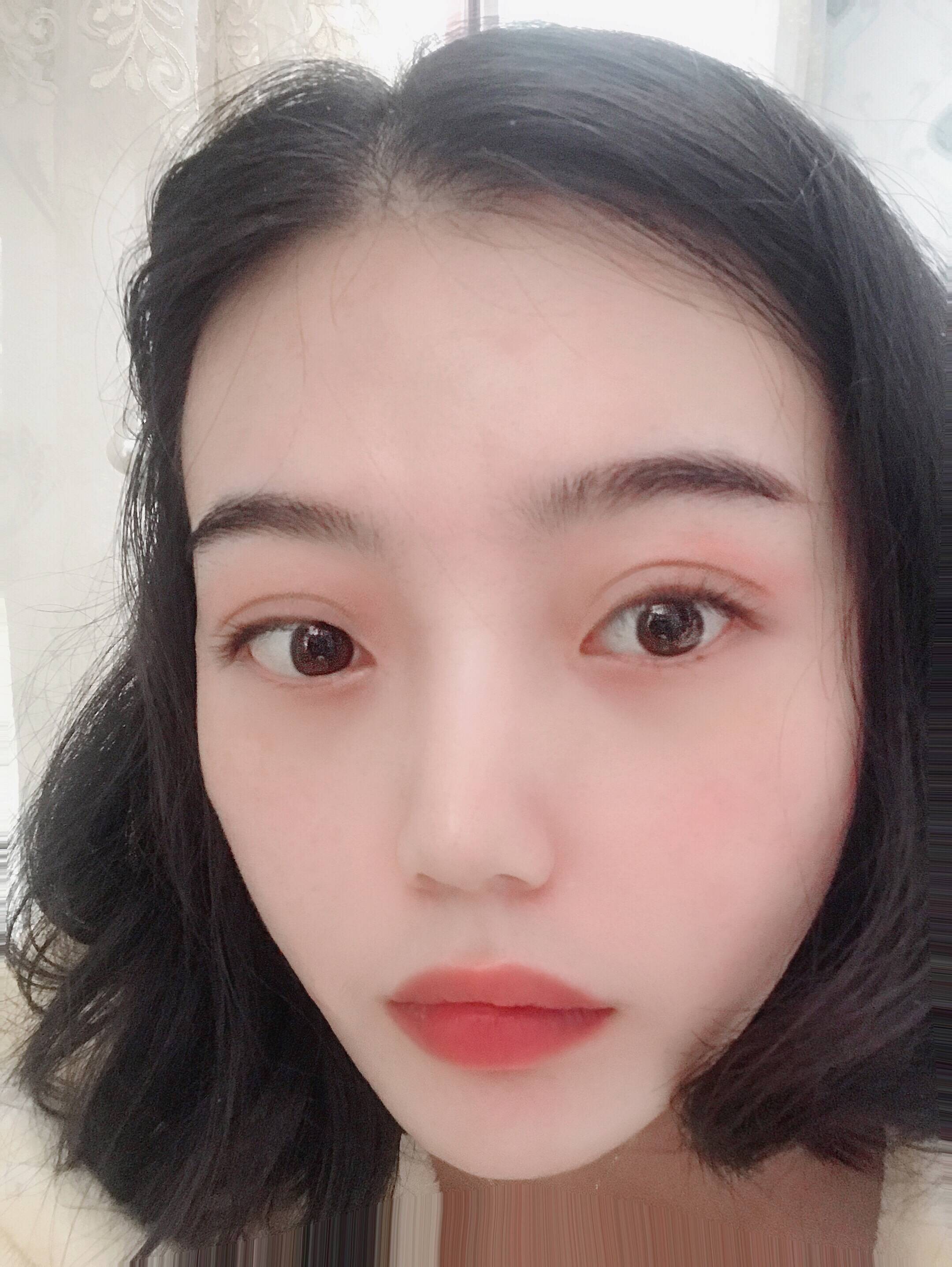 双眼皮手术
