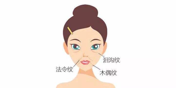 面部提升术
