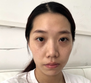 面部提升术