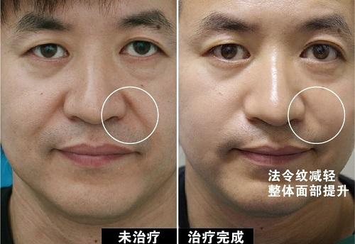 面部提升术