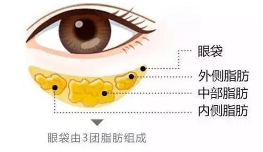 去眼袋手术