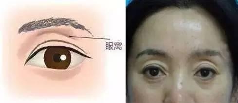 长效玻尿酸