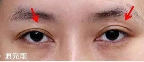 长效玻尿酸
