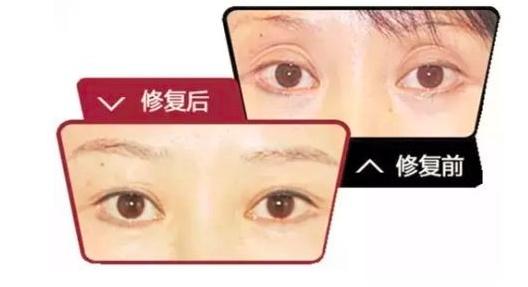 长效玻尿酸