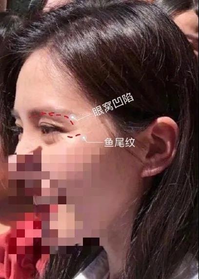 长效玻尿酸