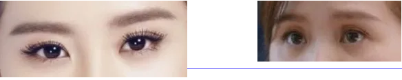 长效玻尿酸