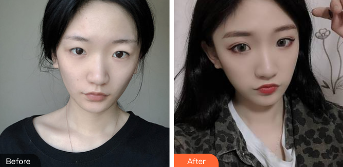 双眼皮手术