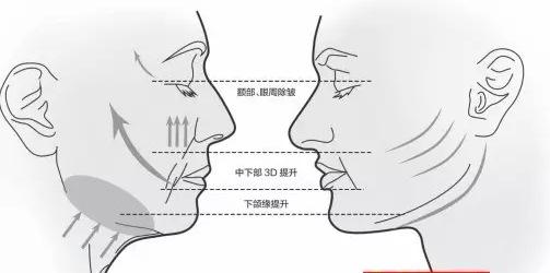 面部提升术