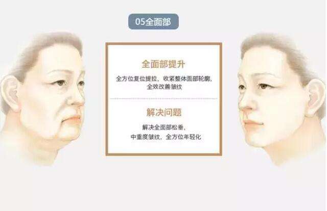 面部提升术