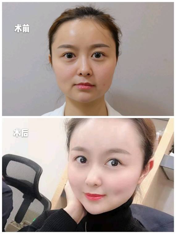 面部提升术