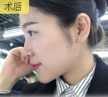 长效玻尿酸