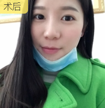 长效玻尿酸