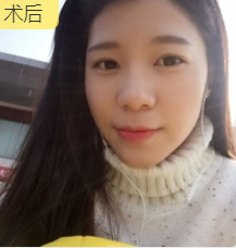 长效玻尿酸