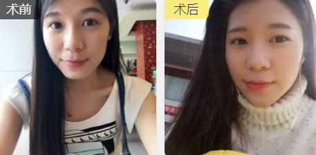 长效玻尿酸