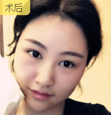 去眼袋手术
