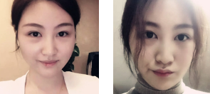 去眼袋手术