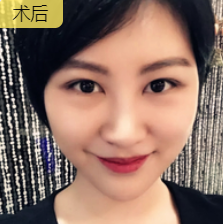 去眼袋手术